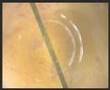 Diagnostic laparoscopy with Visiport insufflations -- gangren