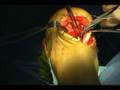 Achilles Repair, Tendon Transfer & Spur Removal Part1 Achilles Repair, Tendon Transfer & Spur Removal Part1