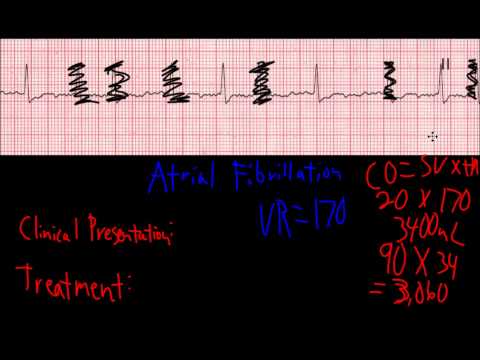 how to treat atrial flutter
