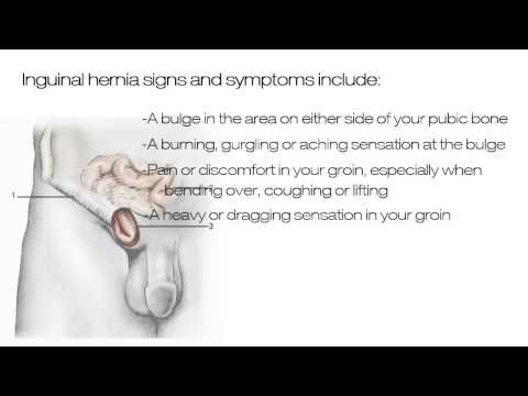 how to exam for inguinal hernia