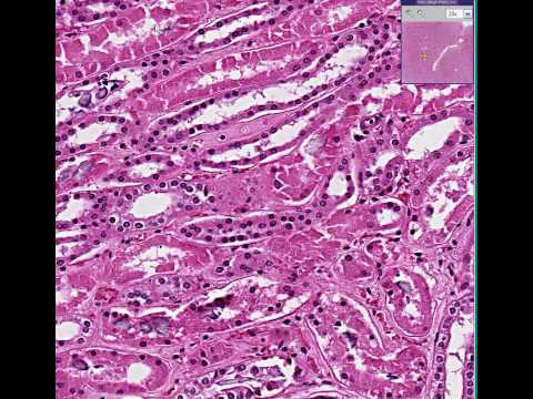 Histopathology Kidney --Acute ...