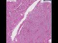Histopathology Kidney --Acute tubular necrosis from ethylene