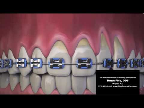how to recover gums