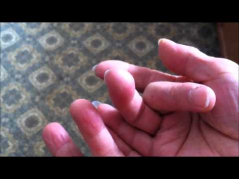 how to treat mild frostbite