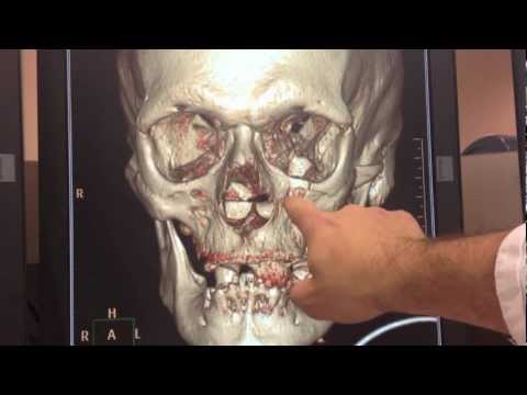 how to treat a zygomatic fracture