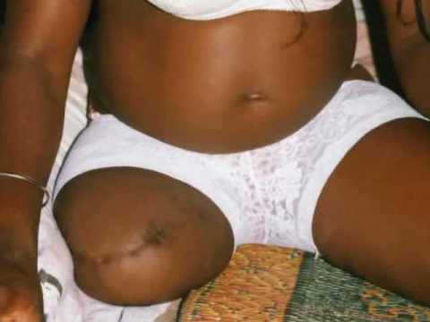 black amputee woman sak right above the knee amputee RAK and model