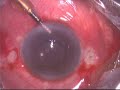 Endophthalmitis Vitrectomy + AC Wash + IV Antibiotic_Part2.flv