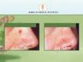 Facial Spider Vein Removal - Watch Them Instanly Dissapear