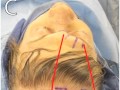 Preoperative Planning Of Anterior Fosssa Management Preoperative Planning Of Anterior Fosssa Management