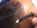 Hair transplant:  creating another female hairline dallas tx