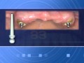 Root Post Overdenture Attachments