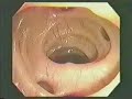 http://www.CaptainColon.com http://www.Volcanohealing.com How to beat constipation, IBS, bloating, stomach pain and skin problems while gaining more energy and a flatter stomach at the same timeIf you once suffered from constipation, IBS, severe gas and bloating, weight gain, chronic fatigue, acid reflux, parasites, stomach pain, diverticulitis, skin and hair problems and many other common ailments. They put an end to their suffering by becoming clean inside as you read every word of this article, I will tell you how they did it - and how you can do it too. If you've been struggling with these problems for some time, chances are you've tried everything to make the pain go away. You've tried laxatives and other OTC and prescription drugs, commercial fiber supplements, maybe even colonoscopy or surgeries. All to no avail as you're still suffering. Why? Because the root cause of the problem was never eliminated.The Root Cause and The Dirtiest SecretSo what is the root cause of most digestive ailments? Look at the picture below. How would you feel if long pieces of old toxin-filled fecal matter were stuck to the inside of your colon for months or even years? Would you feel constipated, bloated and lethargic? Would your bowels be irritated by this debris day in and day out causing what we call IBS? Just think about what else toxic build-up like this can cause? Stomach pain and constipation? Fatigue, gas and bloating? Headaches and indigestion? Weight gain and a large protruding belly? The list is almost endless.