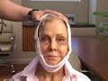 DALLAS PLASTIC SURGERY:  FACELIFT FAT GRAFTING VIDEO JOURNEY