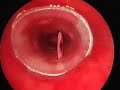 Silicone airway stenting for post-intubation stenosis Silicone airway stenting for post-intubation stenosis