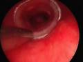 Silicone airway stenting for post-intubation stenosis