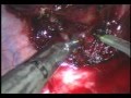 Tumor In Posterior Mediastinum Tumor In Posterior Mediastinum