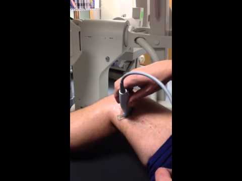 how to harvest a saphenous vein