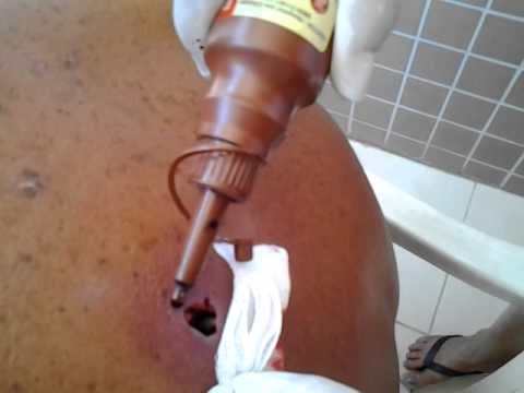 Furunculo do Carlos Henrique