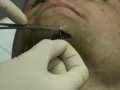 UFC Fighter Frank Edgar Post-Fight Stitches