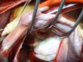 Mitral stenosis僧帽瓣狹窄手術-嘉義長庚心臟外科