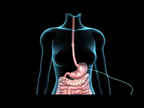 how to unclog a gj feeding tube