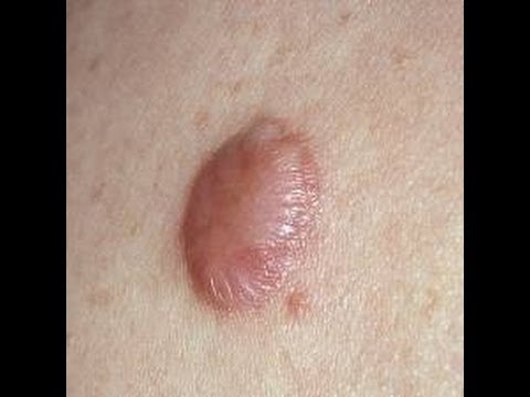 how to avoid keloids