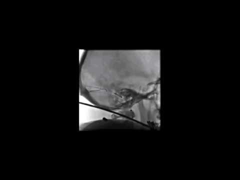 how to treat icp