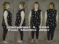 Weight Loss Surgery Journey Segment 1 of 3 EXPOSE