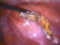 Laparoscopic Appendectomy (laparoskopik apandisit ameliyatı)