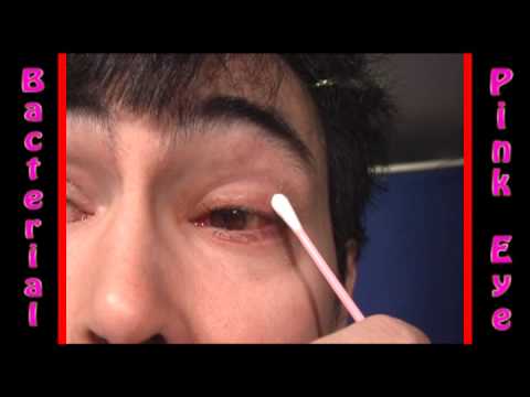how to cure pink eye