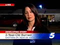 2-Year-Old Burned In Fire Pit