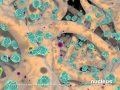 LifeNet: PAD Demineralization
