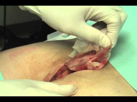 how to treat open boil wound