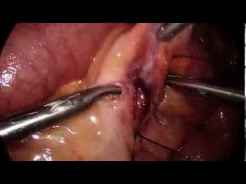 how to relieve biliary colic pain