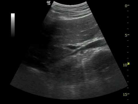 how to treat low cvp