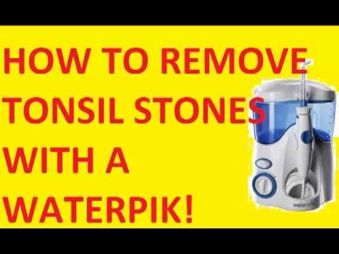 how to remove a tonsil stone with a q-tip