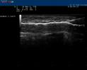 Sclerotherapy Biosound Esaote MyLab, Ultrasound Guided Sclerotherapy Biosound Esaote MyLab, Ultrasound Guided