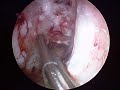 ACL Arthroscopy