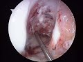 ACL Arthroscopy