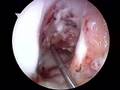 ACL Arthroscopy