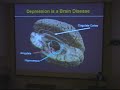 Dr. Sidney Kennedy, Deep Brain Stimulation Pt.3