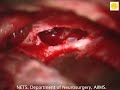 Neurosurgery video petroclival meningioma 2