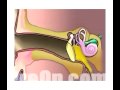 preop® Patient Education Myringotomy Insertion of Tube 1.2