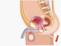 Prostate massage using Dr.Erector prostate stimulator