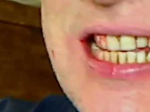 how to drain submandibular abscess