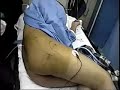 Bloqueo del plexo lumbar