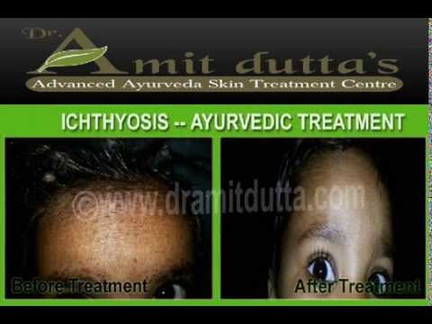 how to cure ichthyosis