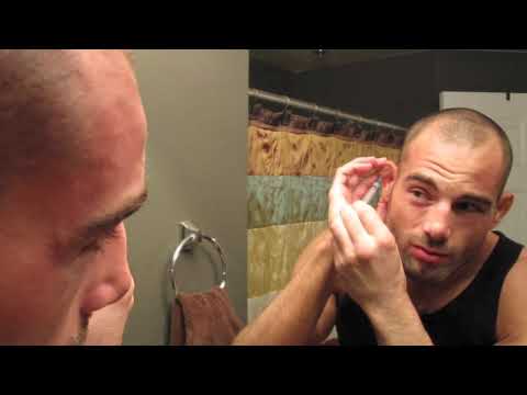 how to treat cauliflower ear