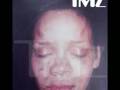 TMZ Releases First REAL Rihanna Injury Photo!