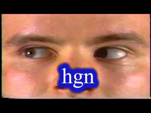 how to perform hgn test